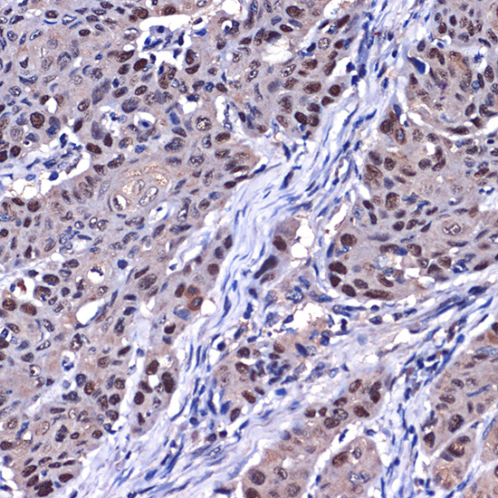 Immunohistochemistry of paraffin-embedded human esophageal cancer using [KO Validated] p53 Polyclonal Antibody at dilution of 1:100 (40x lens).Perform microwave antigen retrieval with 10 mM Tris/EDTA buffer pH 9.0 before commencing with IHC staining protocol.