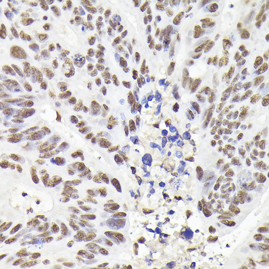 Immunohistochemistry of paraffin-embedded human colon carcinoma using Rad21 Polyclonal Antibody at dilution of 1:200 (40x lens).Perform high pressure antigen retrieval with 10 mM citrate buffer pH 6.0 before commencing with IHC staining protocol.