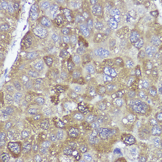 Immunohistochemistry of paraffin-embedded human liver cancer using PYCARD Polyclonal Antibody at dilution of 1:100 (40x lens).Perform high pressure antigen retrieval with 10 mM citrate buffer pH 6.0 before commencing with IHC staining protocol.