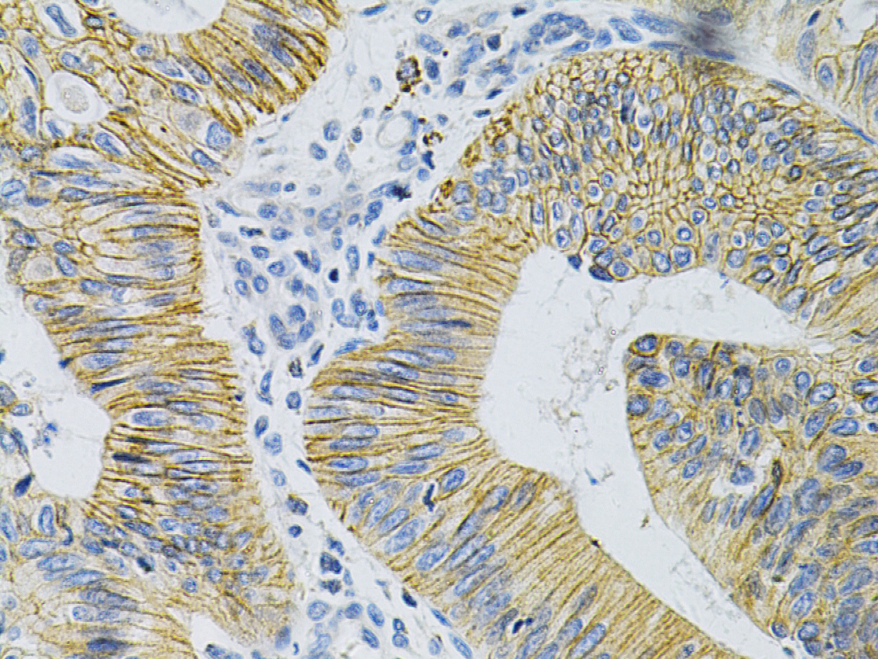 Immunohistochemistry of paraffin-embedded Human colon carcinoma using N-Cadherin Polyclonal Antibody at dilution of 1:100 (40x lens).Perform microwave antigen retrieval with 10 mM PBS buffer pH 7.2 before commencing with IHC staining protocol.