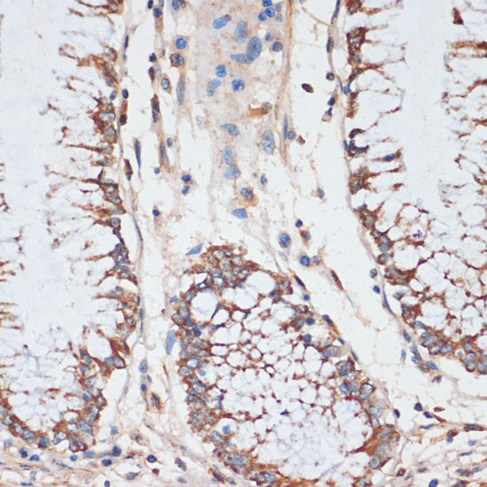 Immunohistochemistry of paraffin-embedded human colon using CDK4 Polyclonal Antibody at dilution of 1:100 (40x lens).Perform microwave antigen retrieval with 10 mM PBS buffer pH 7.2 before commencing with IHC staining protocol.