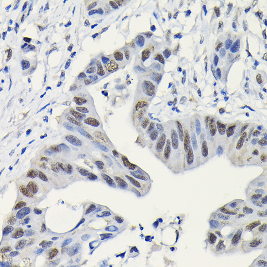 Immunohistochemistry of paraffin-embedded human colon carcinoma using [KO Validated] PARP1 Polyclonal Antibody at dilution of 1:200 (40x lens).Perform high pressure antigen retrieval with 10 mM citrate buffer pH 6.0 before commencing with IHC staining protocol.