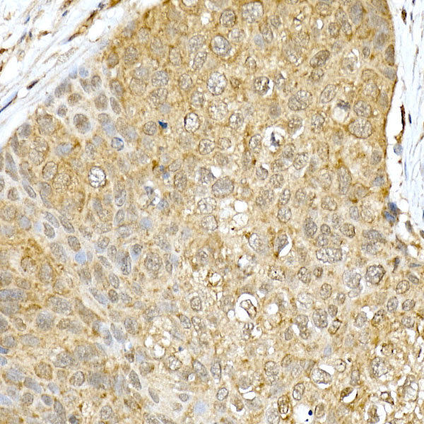 Immunohistochemistry of paraffin-embedded Human esophageal cancer using VDR Polyclonal Antibody at dilution of 1:100 (40x lens).Perform high pressure antigen retrieval with 10 mM citrate buffer pH 6.0 before commencing with IHC staining protocol.