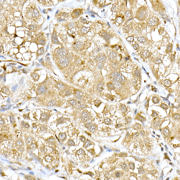 Immunohistochemistry of paraffin-embedded human liver cancer using VDR Polyclonal Antibody at dilution of 1:100 (40x lens).Perform high pressure antigen retrieval with 10 mM citrate buffer pH 6.0 before commencing with IHC staining protocol.