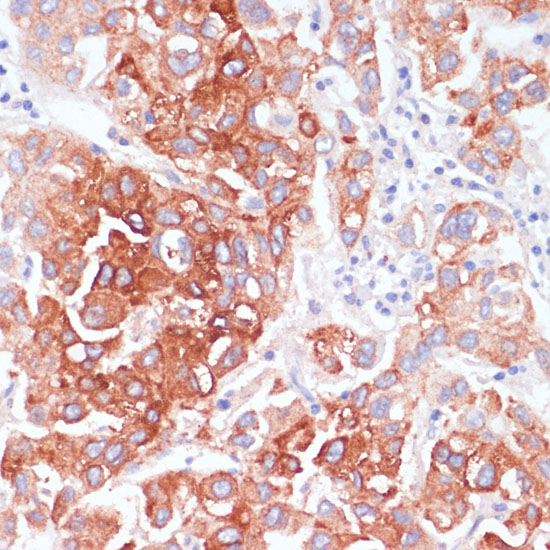 Immunohistochemistry of paraffin-embedded human liver cancer using AKT1 Polyclonal Antibody at dilution of 1:100 (40x lens).Perform microwave antigen retrieval with 10 mM PBS buffer pH 7.2 before commencing with IHC staining protocol.