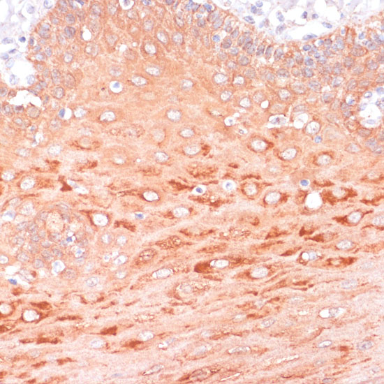 Immunohistochemistry of paraffin-embedded human esophageal using AKT1 Polyclonal Antibody at dilution of 1:100 (40x lens).Perform microwave antigen retrieval with 10 mM PBS buffer pH 7.2 before commencing with IHC staining protocol.