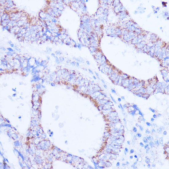 Immunohistochemistry of paraffin-embedded human colon carcinoma using SIRT3 Polyclonal Antibody at dilution of 1:100 (40x lens).Perform microwave antigen retrieval with 10 mM PBS buffer pH 7.2 before commencing with IHC staining protocol.