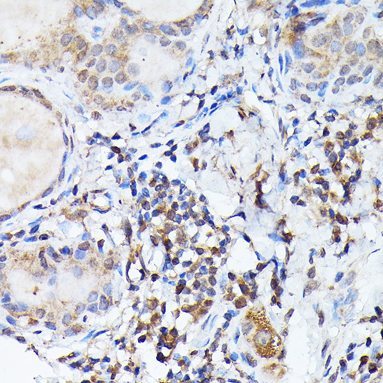 Immunohistochemistry of paraffin-embedded human thyroid cancer using Bcl-2 Polyclonal Antibody at dilution of 1:100 (40x lens).Perform high pressure antigen retrieval with 10 mM citrate buffer pH 6.0 before commencing with IHC staining protocol.