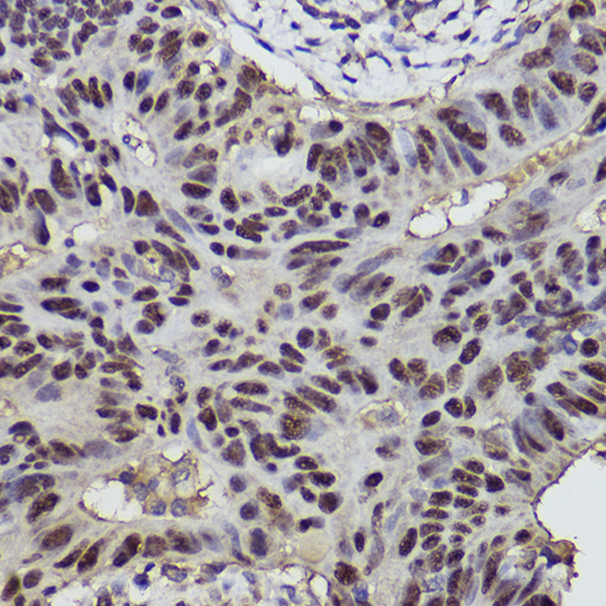 Immunohistochemistry of paraffin-embedded human colon carcinoma using [KO Validated] p53 Polyclonal Antibody at dilution of 1:300 (40x lens).Perform high pressure antigen retrieval with 10 mM citrate buffer pH 6.0 before commencing with IHC staining protocol.