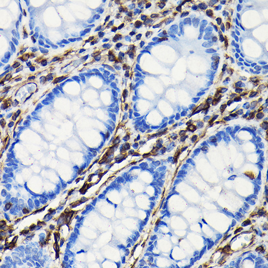 Immunohistochemistry of paraffin-embedded human colon using Vimentin Polyclonal Antibody at dilution of 1:100 (40x lens).Perform high pressure antigen retrieval with 10 mM citrate buffer pH 6.0 before commencing with IHC staining protocol.