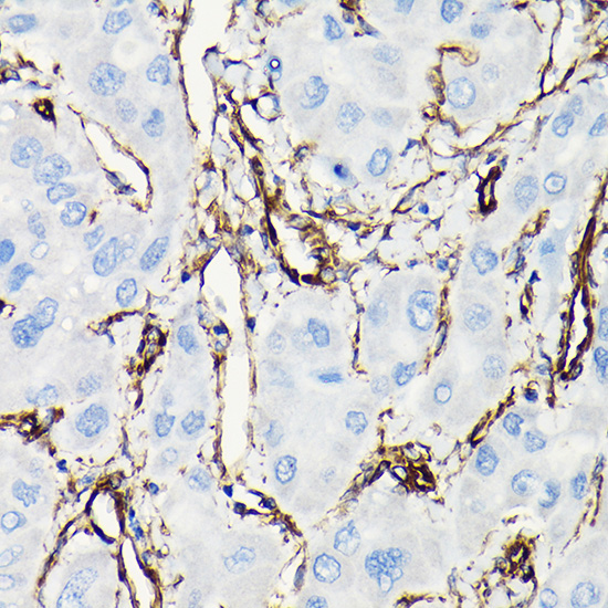 Immunohistochemistry of paraffin-embedded human liver cancer using Vimentin Polyclonal Antibody at dilution of 1:100 (40x lens).Perform high pressure antigen retrieval with 10 mM citrate buffer pH 6.0 before commencing with IHC staining protocol.