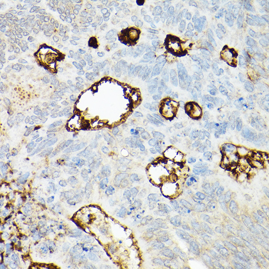 Immunohistochemistry of paraffin-embedded human colon carcinoma using CD133 Polyclonal Antibody at dilution of 1:200 (40x lens).Perform high pressure antigen retrieval with 10 mM citrate buffer pH 6.0 before commencing with IHC staining protocol.