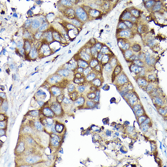 Immunohistochemistry of paraffin-embedded Human lung adenocarcinoma using SQSTM1/p62 Polyclonal Antibody at dilution of 1:100 (40x lens).Perform high pressure antigen retrieval with 10 mM citrate buffer pH 6.0 before commencing with IHC staining protocol.