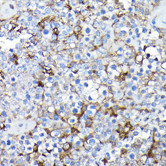 Immunohistochemistry of paraffin-embedded Human extranodal NK-T cell lymphoma using SQSTM1/p62 Polyclonal Antibody at dilution of 1:100 (40x lens).Perform high pressure antigen retrieval with 10 mM citrate buffer pH 6.0 before commencing with IHC staining