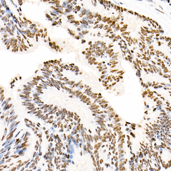 Immunohistochemistry of paraffin-embedded human colon carcinoma using [KO Validated] HNRNPA2B1 Polyclonal Antibody at dilution of 1:20 (40x lens).Perform high pressure antigen retrieval with 10 mM citrate buffer pH 6.0 before commencing with IHC staining protocol.