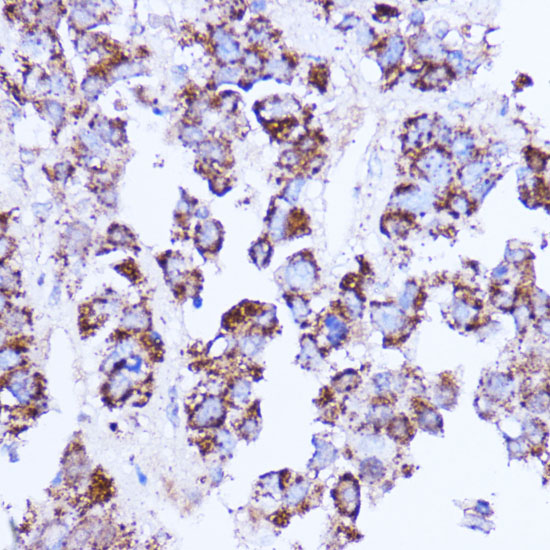 Immunohistochemistry of paraffin-embedded human liver cancer using SHMT2 Polyclonal Antibody at dilution of 1:100 (40x lens).Perform microwave antigen retrieval with 10 mM PBS buffer pH 7.2 before commencing with IHC staining protocol.