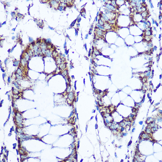 Immunohistochemistry of paraffin-embedded human colon using SOD2 Polyclonal Antibody at dilution of 1:100 (40x lens).Perform microwave antigen retrieval with 10 mM Tris/EDTA buffer pH 9.0 before commencing with IHC staining protocol.