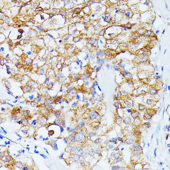 Immunohistochemistry of paraffin-embedded human mammary cancer using ECE1 Polyclonal Antibody at dilution of 1:100 (40x lens).Perform microwave antigen retrieval with 10 mM PBS buffer pH 7.2 before commencing with IHC staining protocol.