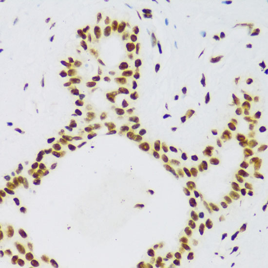 Immunohistochemistry of paraffin-embedded human breast cancer using FUS Polyclonal Antibody at dilution of 1:100 (40x lens).Perform microwave antigen retrieval with 10 mM PBS buffer pH 7.2 before commencing with IHC staining protocol.