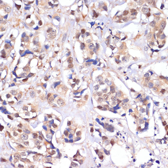 Immunohistochemistry of paraffin-embedded human breast cancer using MST1/STK4 Polyclonal Antibody at dilution of 1:100 (40x lens).Perform microwave antigen retrieval with 10 mM PBS buffer pH 7.2 before commencing with IHC staining protocol.