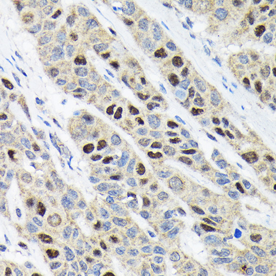 Immunohistochemistry of paraffin-embedded Human esophageal cancer using Ki67 Polyclonal Antibody at dilution of 1:100 (40x lens).Perform microwave antigen retrieval with 10 mM Tris/EDTA buffer pH 9.0 before commencing with IHC staining protocol.