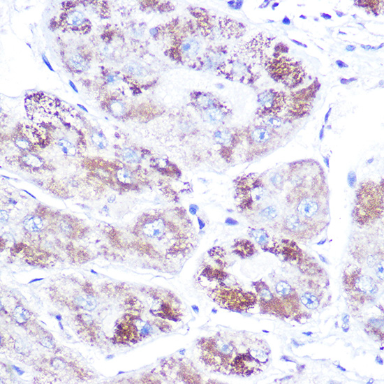 Immunohistochemistry of paraffin-embedded human liver cancer using Mineralocorticoid receptor Polyclonal Antibody at dilution of 1:100 (40x lens).Perform high pressure antigen retrieval with 10 mM citrate buffer pH 6.0 before commencing with IHC staining protocol.