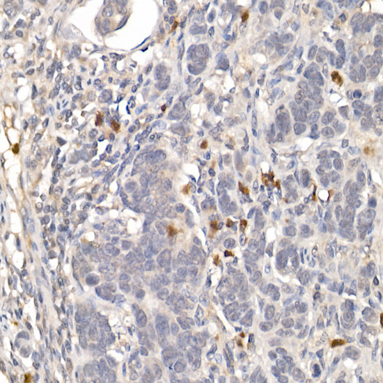 Immunohistochemistry of paraffin-embedded human colon carcinoma using NUR77 Polyclonal Antibody at dilution of 1:100 (40x lens).Perform high pressure antigen retrieval with 10 mM citrate buffer pH 6.0 before commencing with IHC staining protocol.