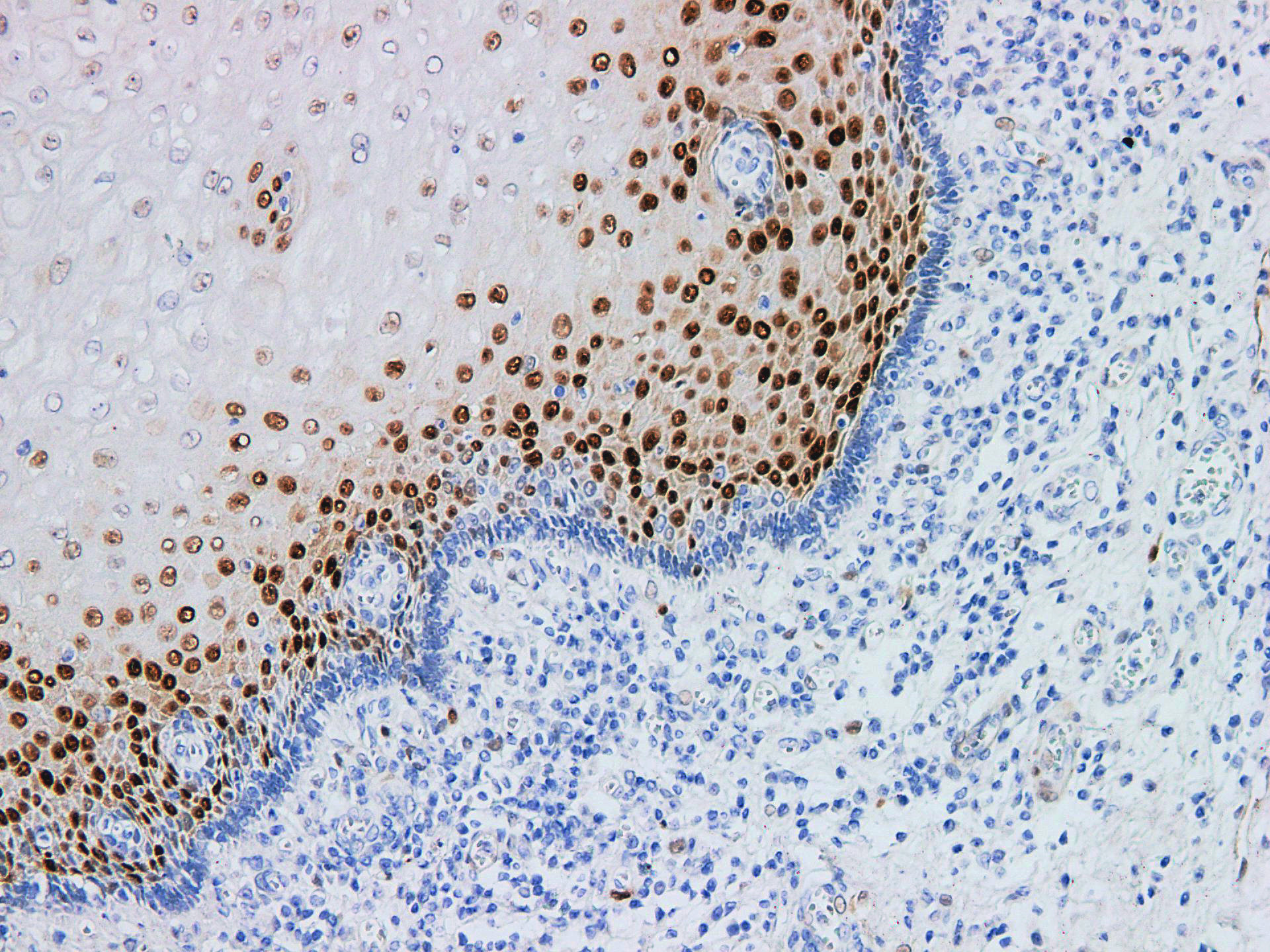 Immunohistochemistry of paraffinembedded Human esophageal squamous cell carcinoma with Cytokeratin 17 Monoclonal Antibody(Antigen repaired by EDTA).