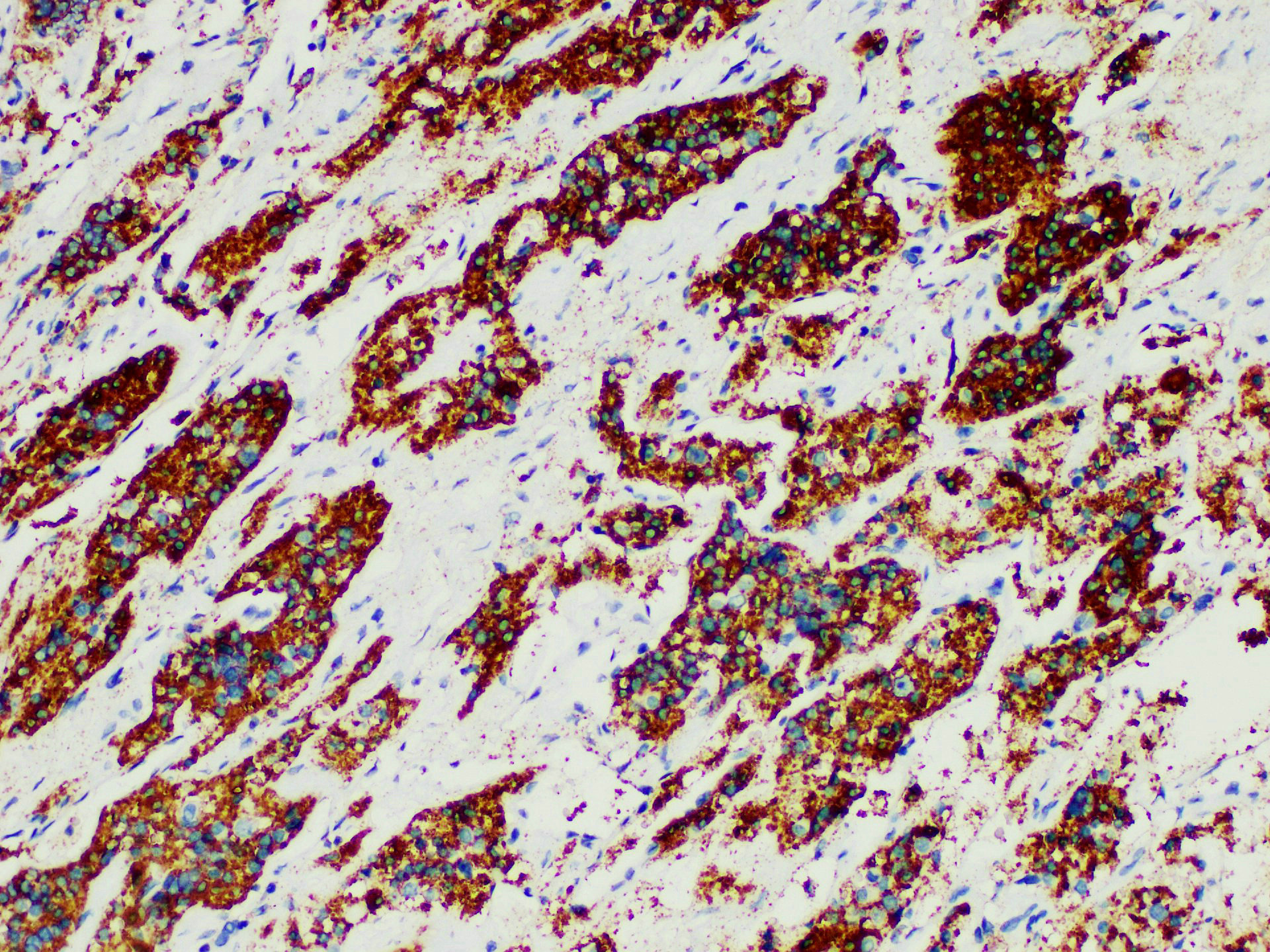 Immunohistochemistry of paraffinembedded Human Pituitary tumor tissue with ACTH Monoclonal Antibody(Antigen repaired by EDTA).