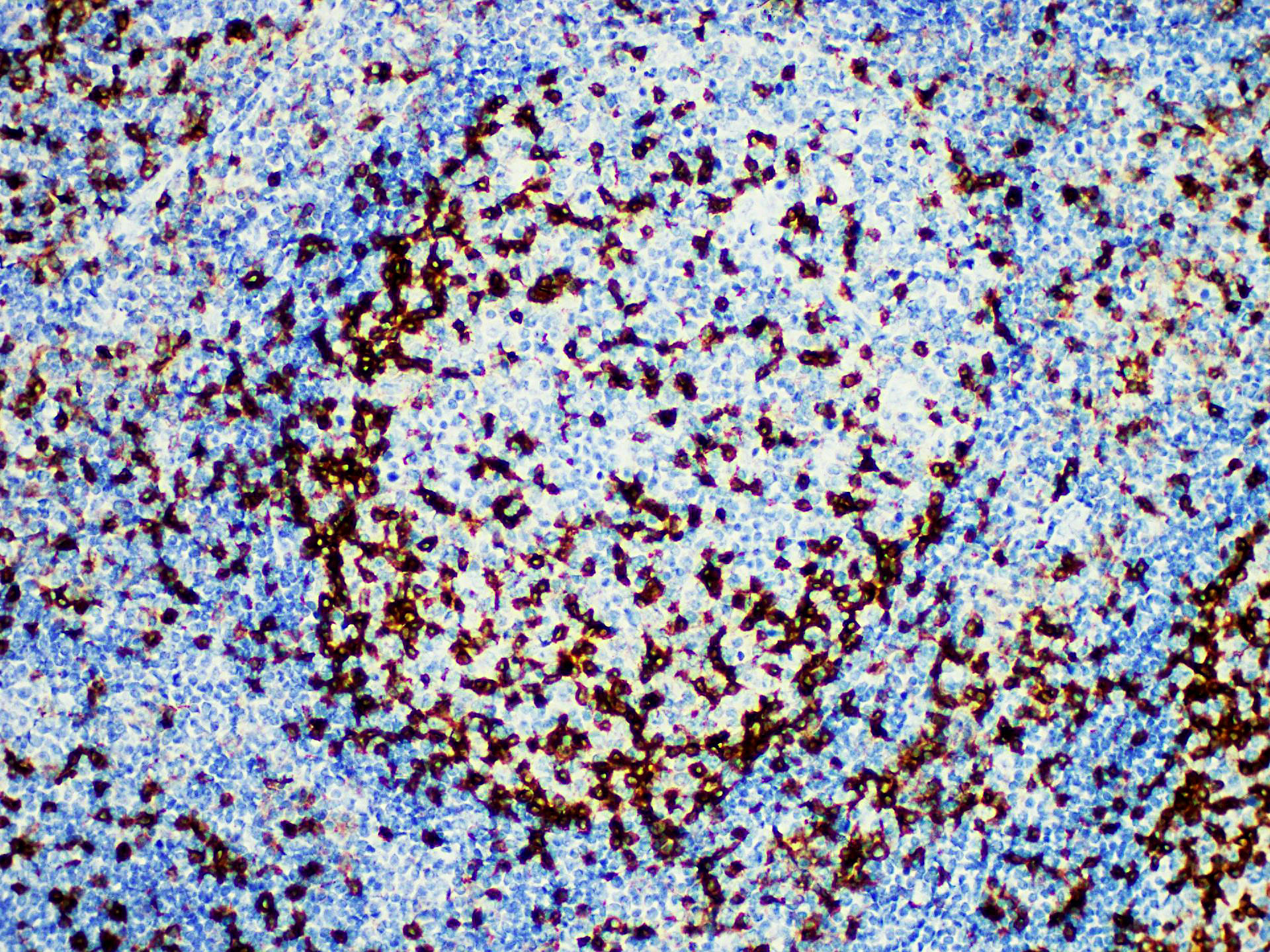 Immunohistochemistry of paraffinembedded Human tonsil tissue with PD-1 Monoclonal Antibody(Antigen repaired by EDTA).