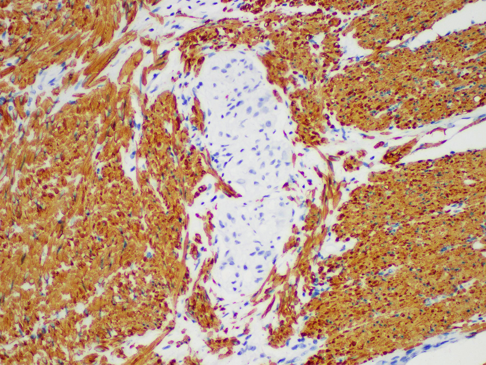 Immunohistochemistry of paraffinembedded Human colon tissue with Actin pan Monoclonal Antibody(Antigen repaired by EDTA).
