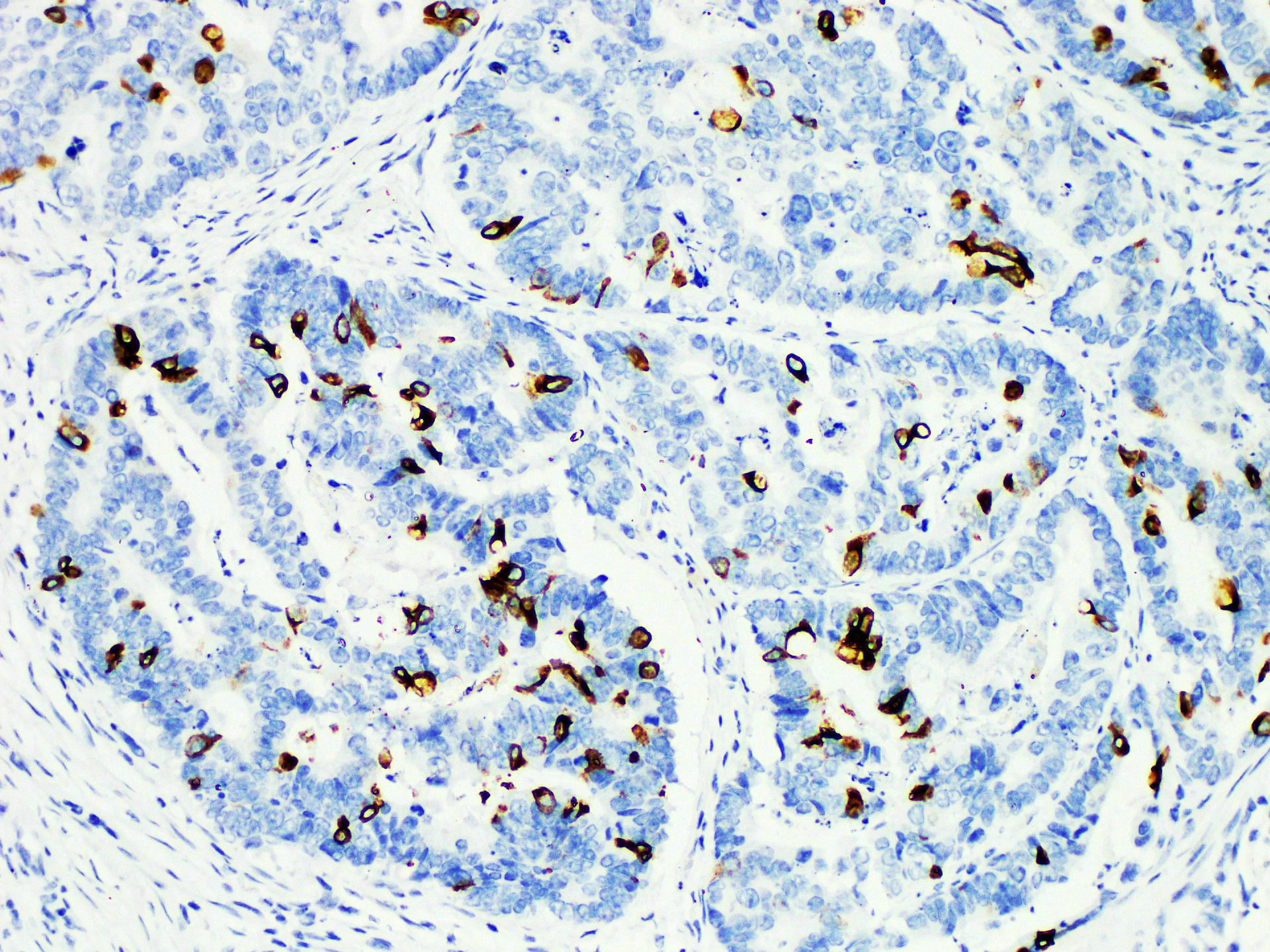 Immunohistochemistry of paraffinembedded Human colon cancer tissue with MUC2 Monoclonal Antibody(Antigen repaired by EDTA).