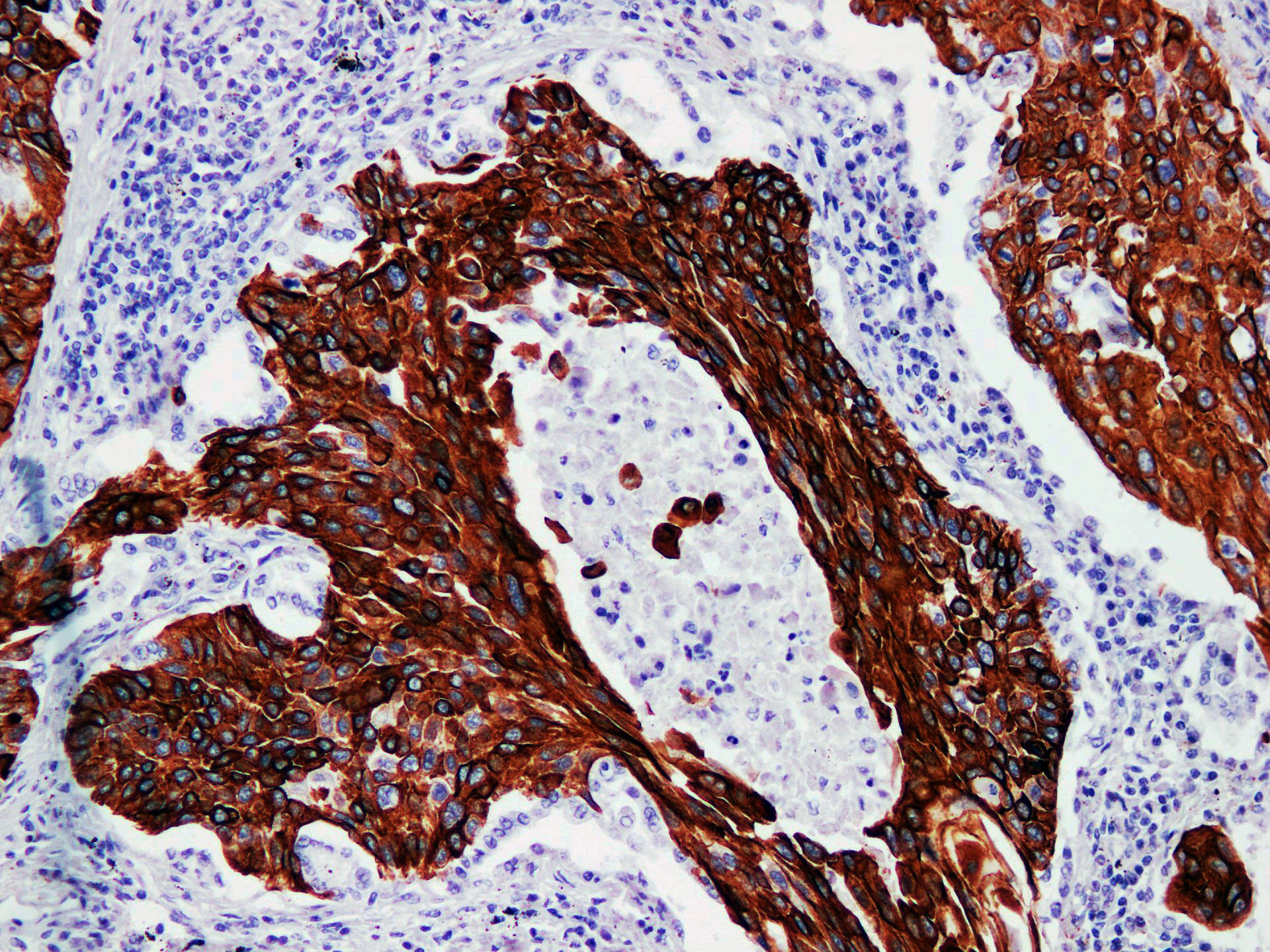Immunohistochemistry of paraffinembedded Human lung squamous cell carcinoma with Cytokeratin 17 Monoclonal Antibody(Antigen repaired by EDTA).