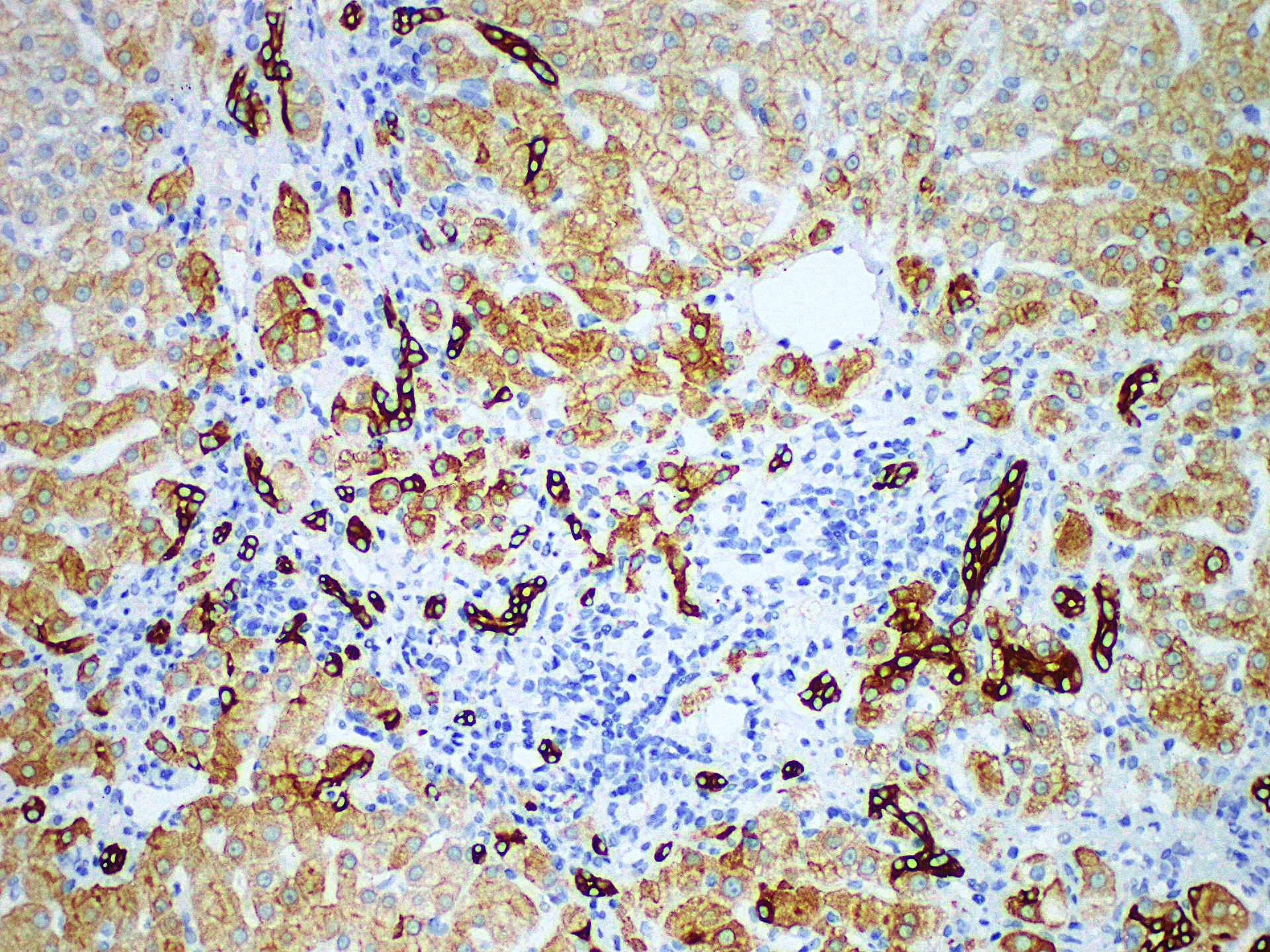 Immunohistochemistry of paraffinembedded Human liver tissue with CK8 Monoclonal Antibody(Antigen repaired by EDTA).