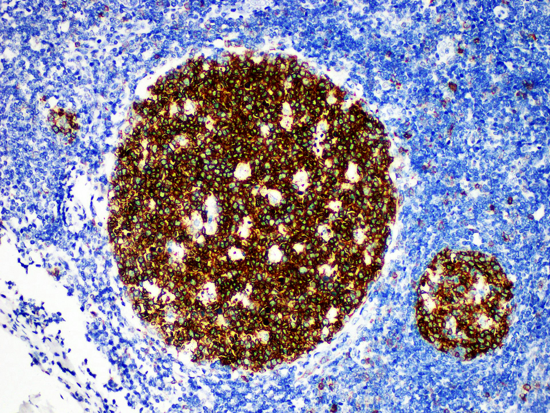 Immunohistochemistry of paraffinembedded Human tonsil tissue with Stathmin Monoclonal Antibody(Antigen repaired by EDTA).