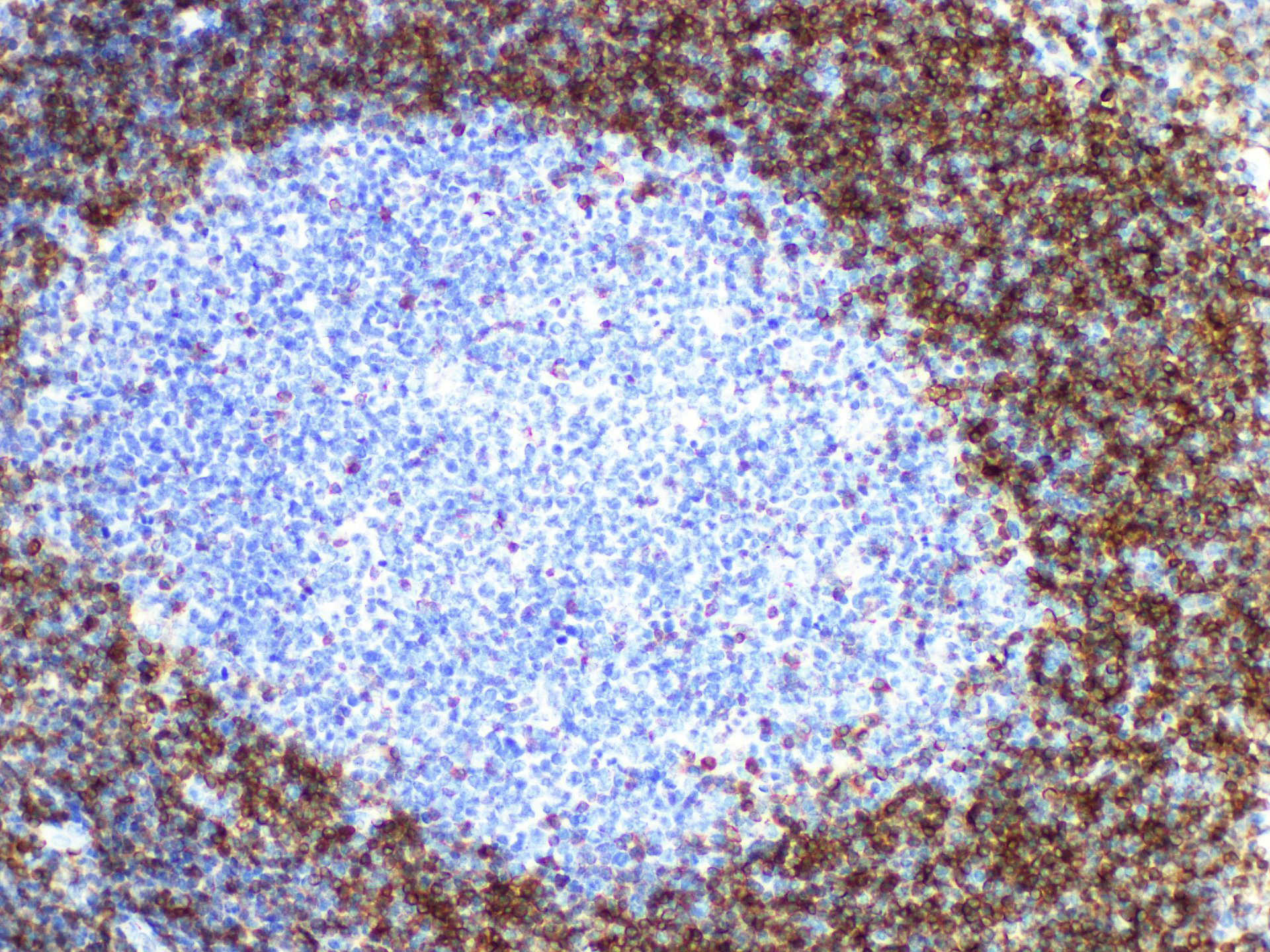 Immunohistochemistry of paraffinembedded Human lymphaden tissue with BCL2 Monoclonal Antibody(Antigen repaired by EDTA).