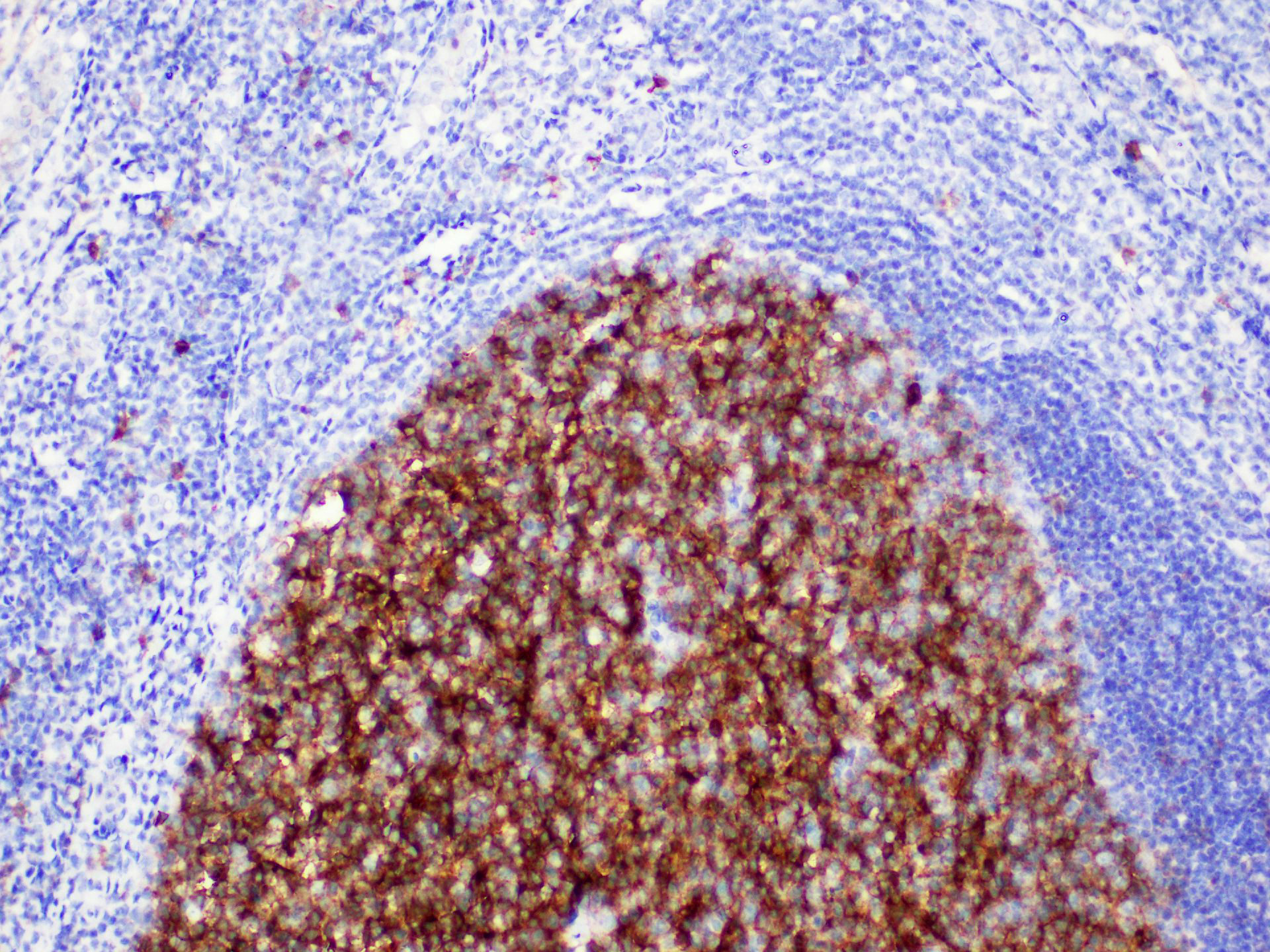 Immunohistochemistry of paraffinembedded Human tonsil tissue with CD10 Monoclonal Antibody(Antigen repaired by EDTA).
