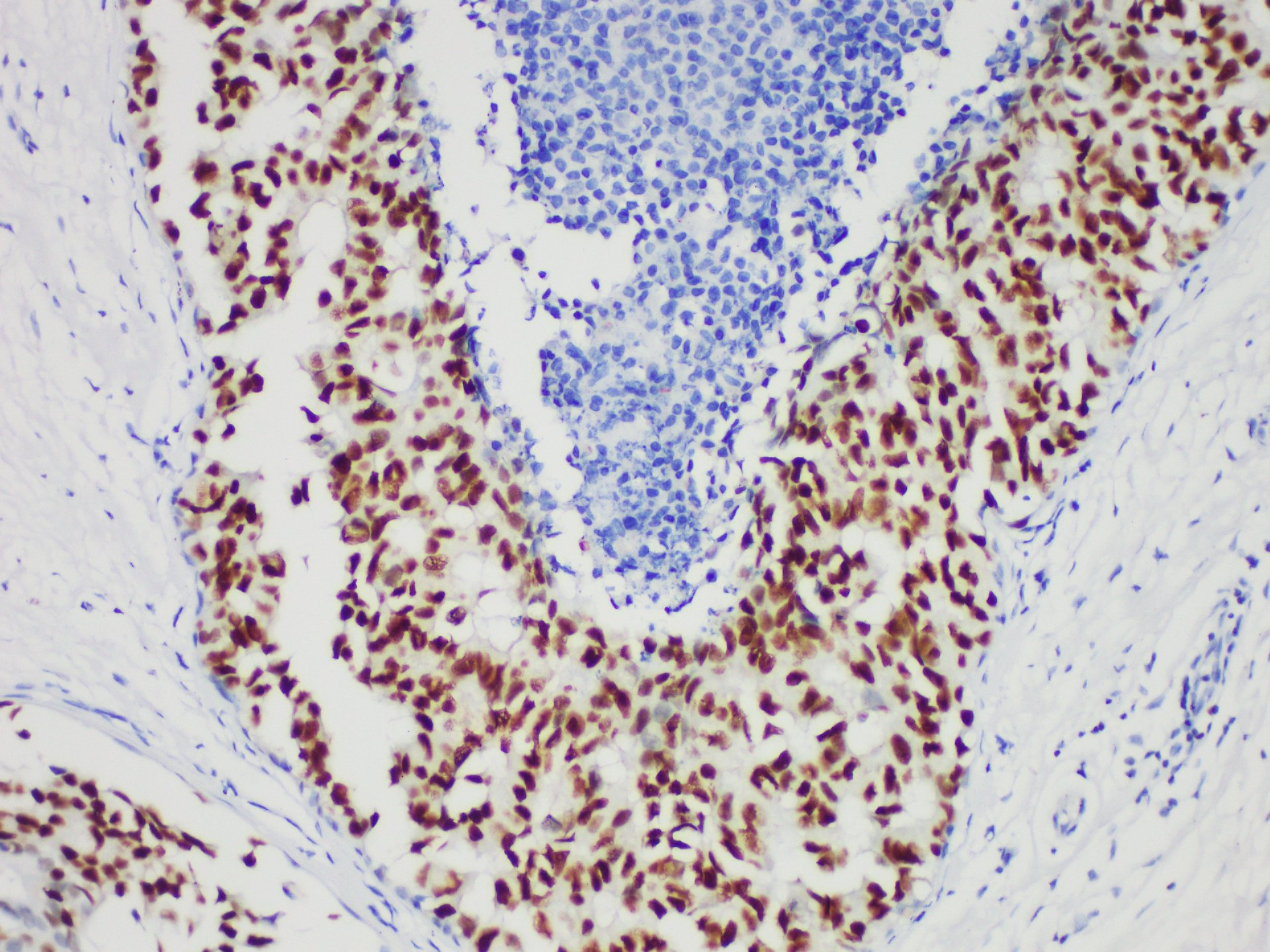 Immunohistochemistry of paraffinembedded Human Breast cancer with GATA3 Monoclonal Antibody(Antigen repaired by EDTA).