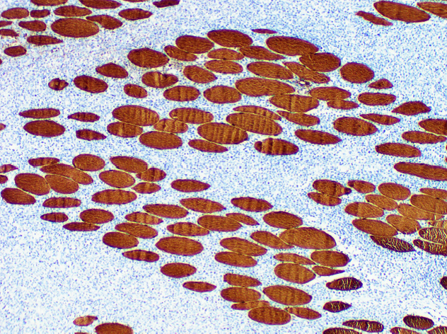 Immunohistochemistry of paraffinembedded Human striated muscle tissue with Myoglobin Monoclonal Antibody(Antigen repaired by EDTA).
