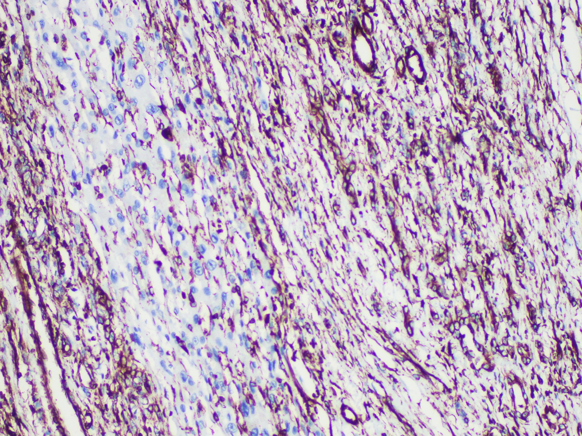Immunohistochemistry of paraffinembedded Human liver tissue with Vimentin Monoclonal Antibody(Antigen repaired by EDTA).