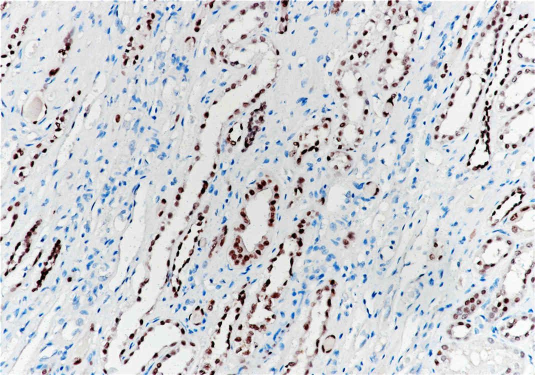 Immunohistochemistry of paraffinembedded Human kidney tissue with Pax-2 Monoclonal Antibody(Antigen repaired by EDTA).