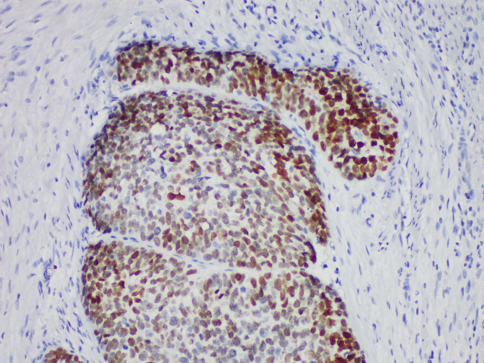 Immunohistochemistry of paraffinembedded Human esophageal squamous cell carcinoma with SOX-2 Monoclonal Antibody(Antigen repaired by EDTA).