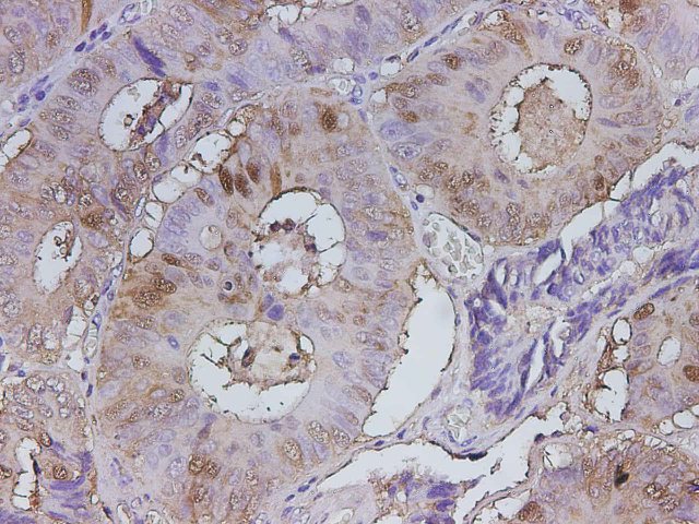 Immunohistochemistry of paraffin-embedded Human colon cancer using LGALS3 Polyclonal Antibody at dilution of 1:300