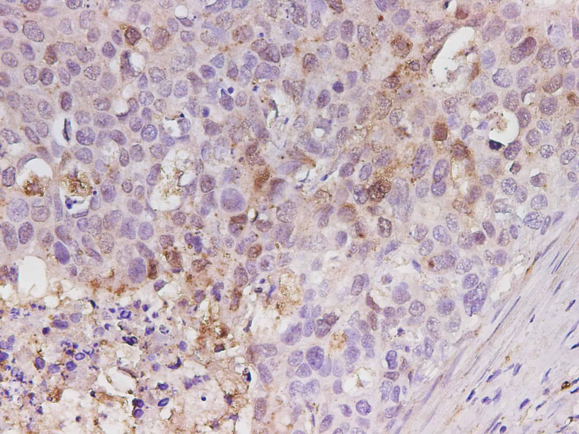 Immunohistochemistry of paraffin-embedded Human stomach cancer using LGALS3 Polyclonal Antibody at dilution of 1:300