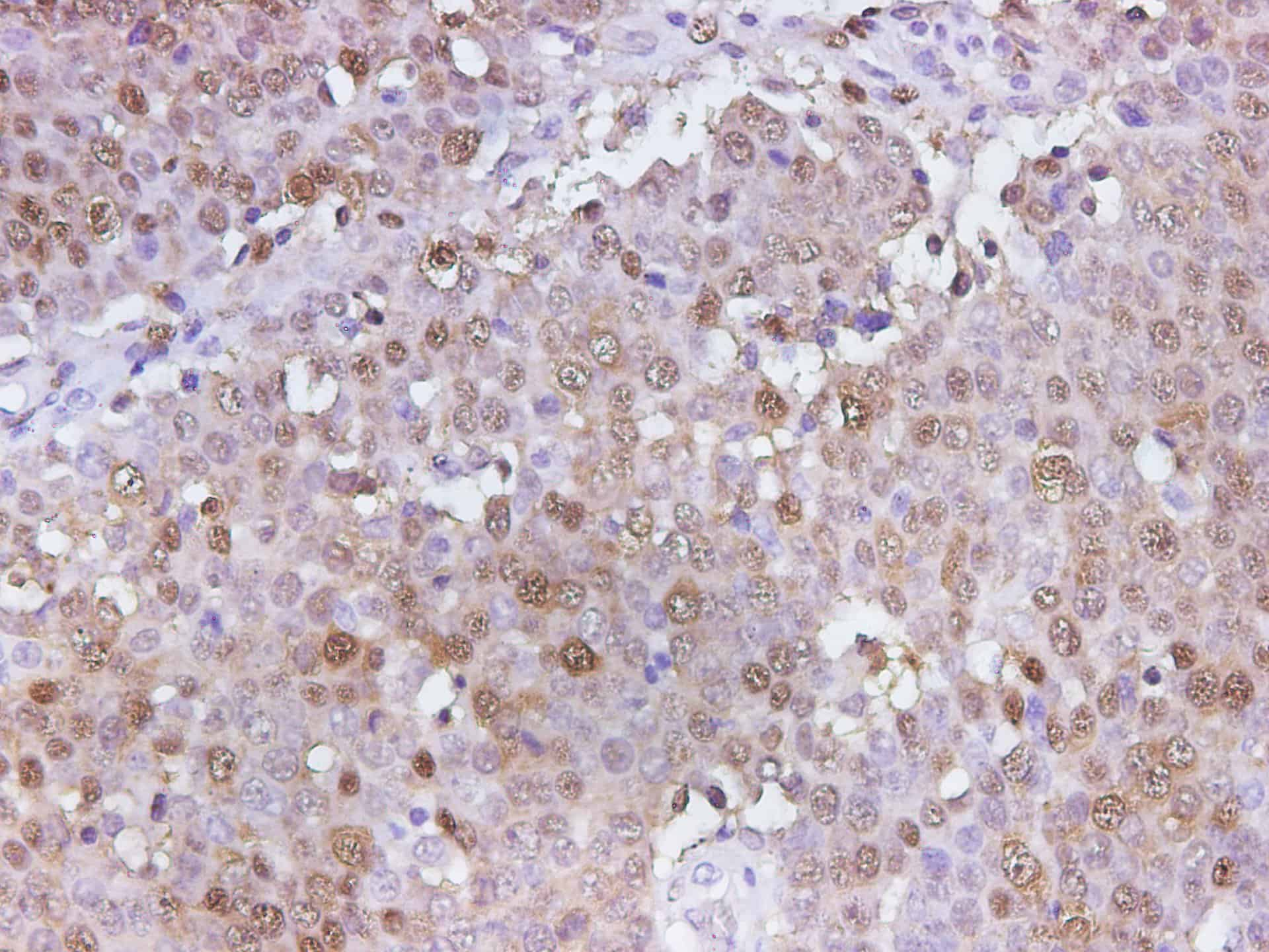 Immunohistochemistry of paraffin-embedded Human ovary cancer using S100A6 Polyclonal Antibody at dilution of 1:350