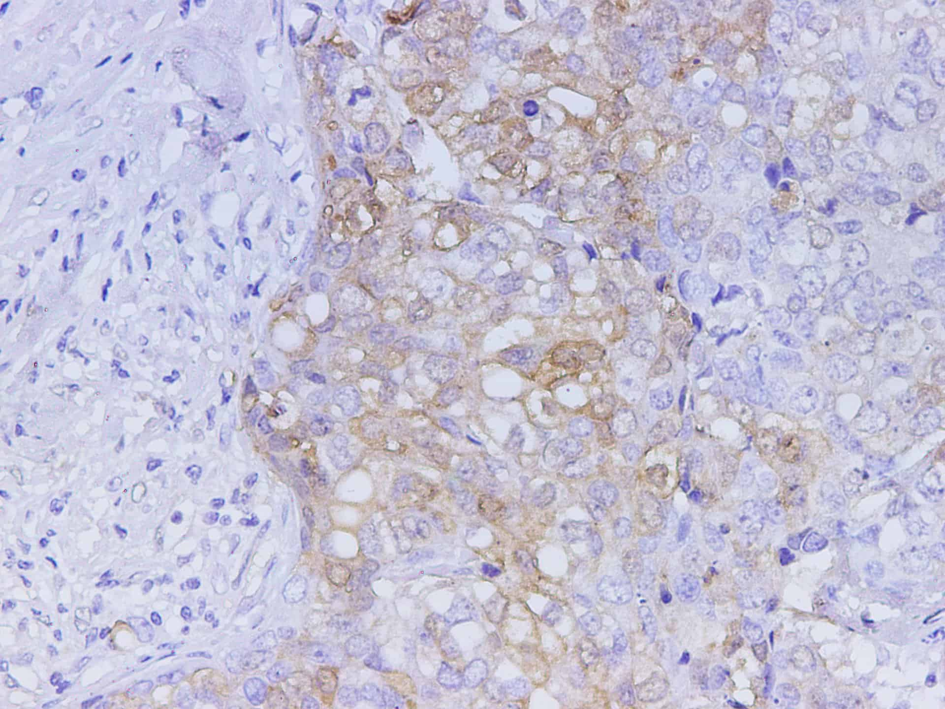 Immunohistochemistry of paraffin-embedded Human breast cancer using S100A6 Polyclonal Antibody at dilution of 1:350