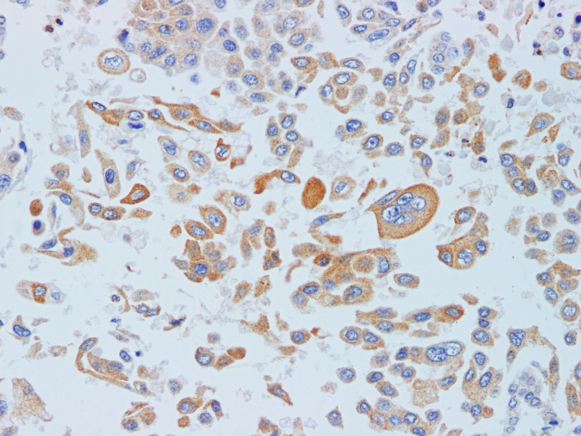 Immunohistochemistry of paraffin-embedded Human lung cancer using IFITM3 Polyclonal Antibody at dilution of 1:200