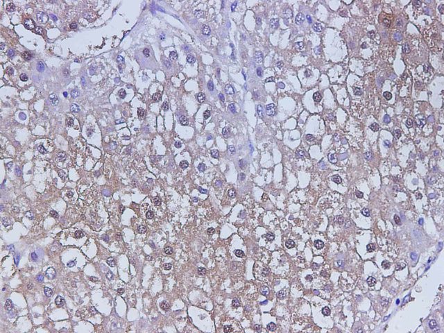 Immunohistochemistry of paraffin-embedded Human liver cancer using CST3 Polyclonal Antibody at dilution of 1:500