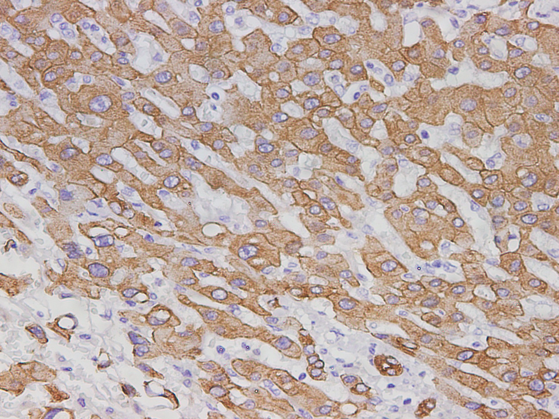 Immunohistochemistry of paraffin-embedded Human liver cancer tissue using AGR1 Polyclonal Antibody at dilution of 1:2900