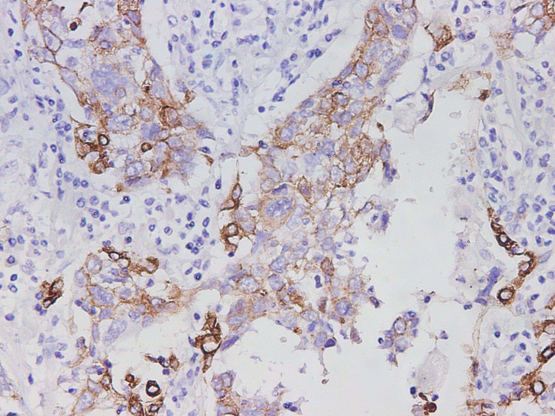 Immunohistochemistry of paraffin-embedded Human lung cancer tissue using AGR1 Polyclonal Antibody at dilution of 1:2900